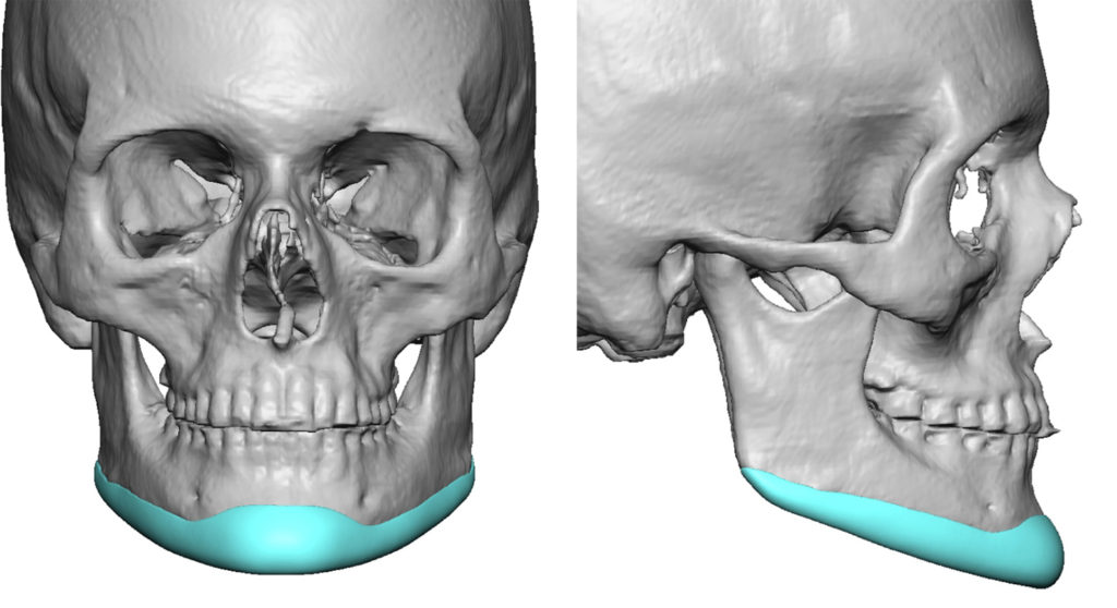 The Female Custom Jawline Implant Design - Explore Plastic Surgery