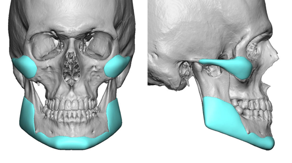 Total jaw implant
