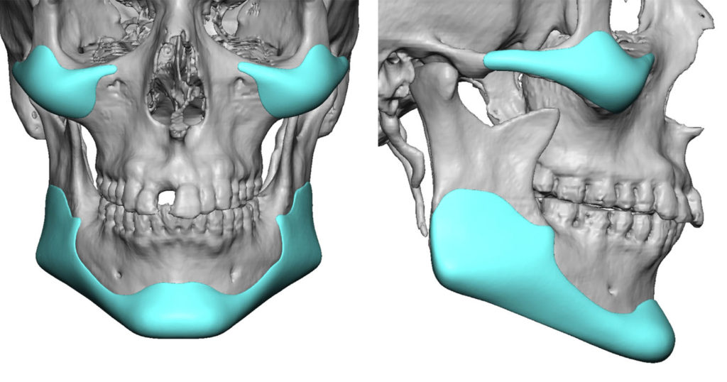 Total jaw implant