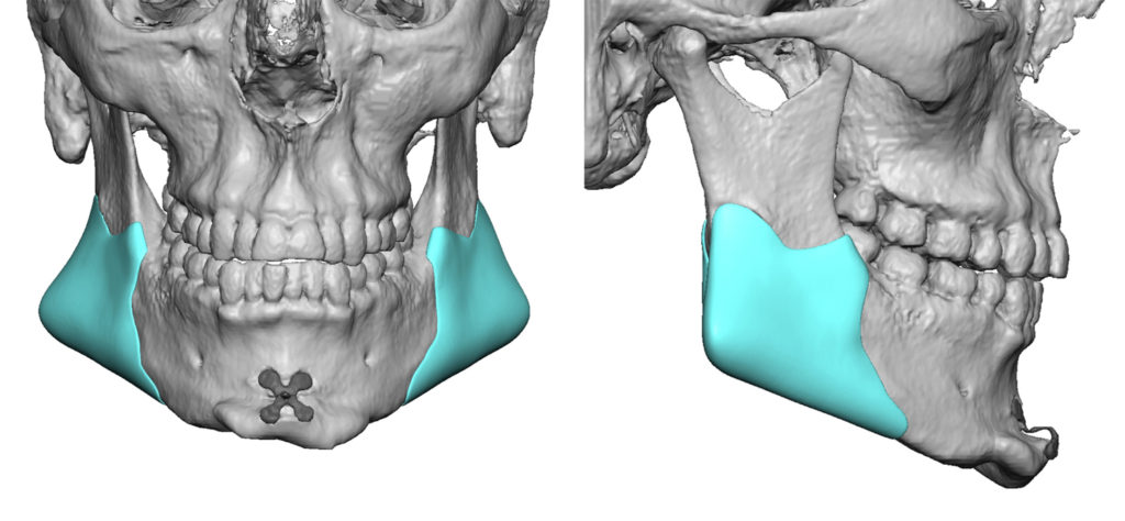 Custom Jaw Implants - Chin Implants