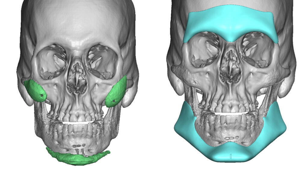 Total Face Implants | Eppley Custom Facial Implants