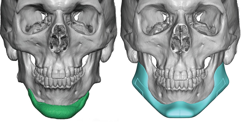 Custom Jaw Implants - Chin Implants | Eppley Custom Facial Implants