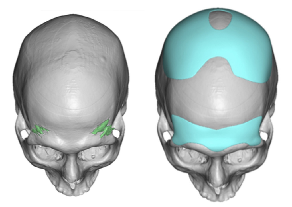 Aesthetic Skull Reshaping