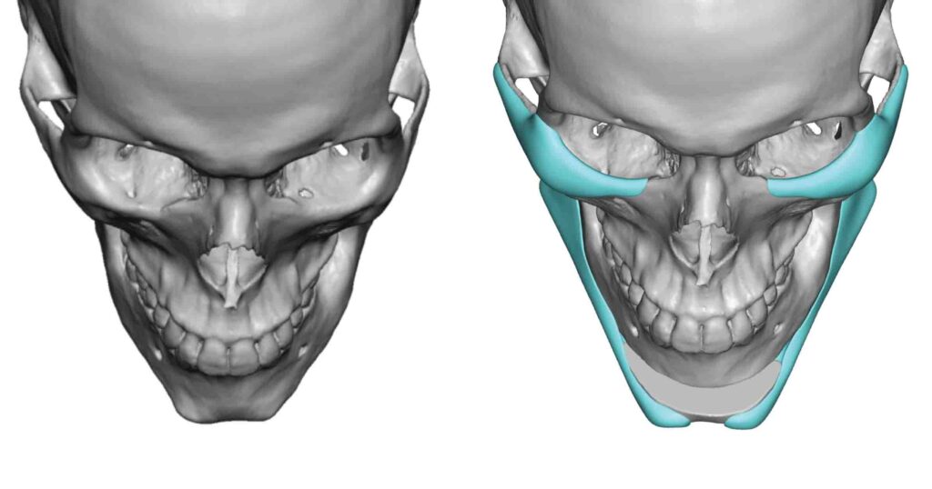 Custom Jaw Implants - Chin Implants